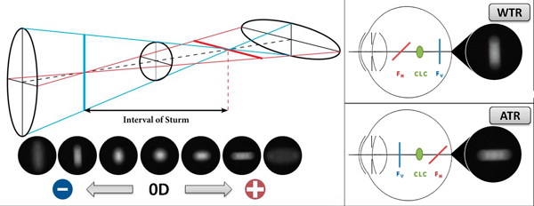 astigmatism