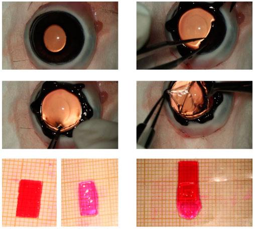 intraocularlenses